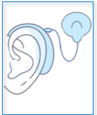 Cochlear Implant