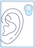Bone-Anchored Hearing Aid