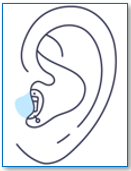Completely-in-Canal (CIC) Hearing Aid