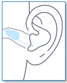 Invisible-in-Canal (IIC) Hearing Aid